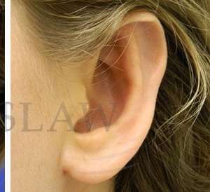 Otoplasty Before & After Patient #1051