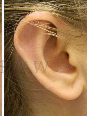 Otoplasty Before & After Patient #1051