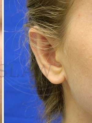 Otoplasty Before & After Patient #1051
