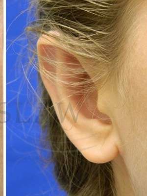 Otoplasty Before & After Patient #1051