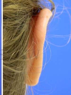 Otoplasty Before & After Patient #1051