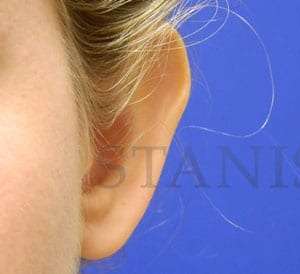 Otoplasty Before & After Patient #1051