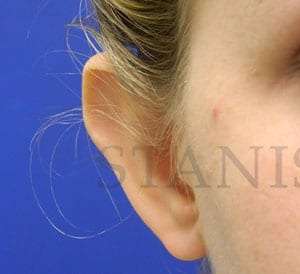 Otoplasty Before & After Patient #1051
