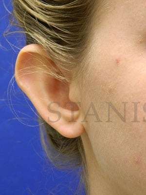 Otoplasty Before & After Patient #1051