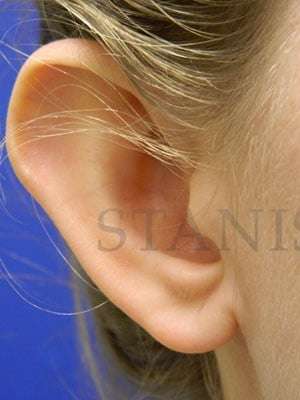 Otoplasty Before & After Patient #1051