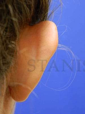 Otoplasty Before & After Patient #1051