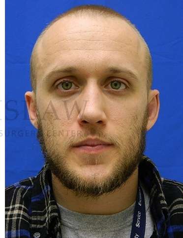 Otoplasty Before & After Patient #1032