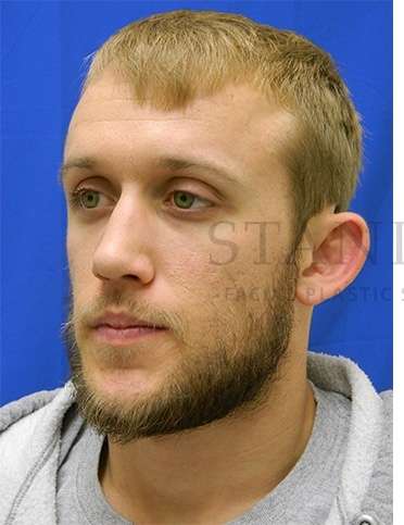 Otoplasty Before & After Patient #1032