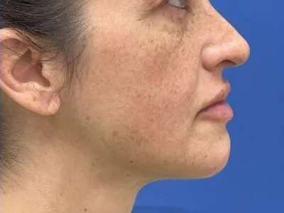 Lip Filler Before & After Patient #660