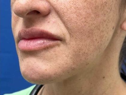 Lip Filler Before & After Patient #660