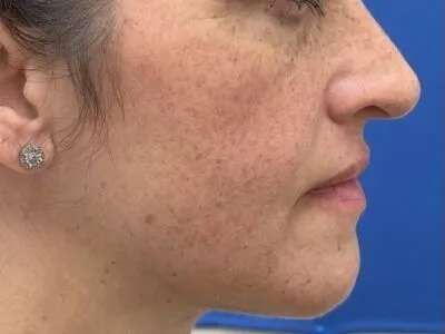Lip Filler Before & After Patient #660