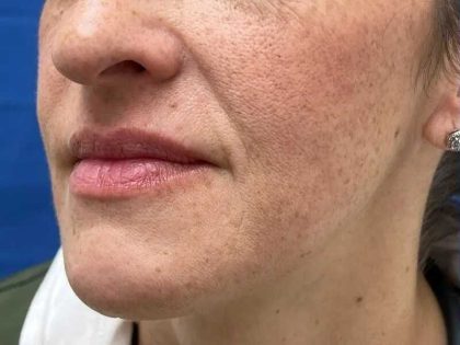 Lip Filler Before & After Patient #660