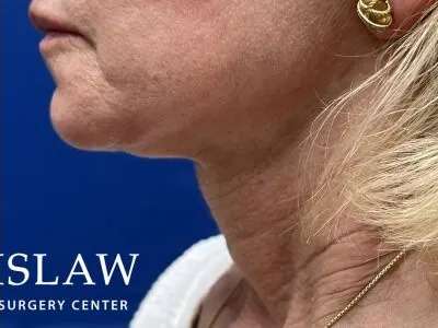 Face/Neck Lift Before & After Patient #470