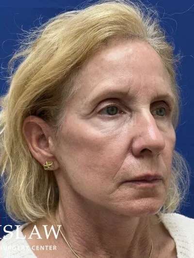 Face/Neck Lift Before & After Patient #470