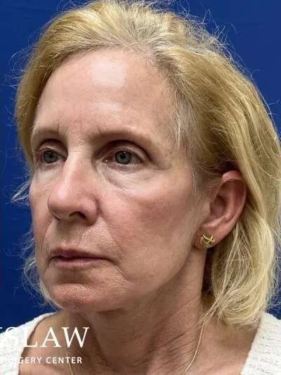 Face/Neck Lift Before & After Patient #470