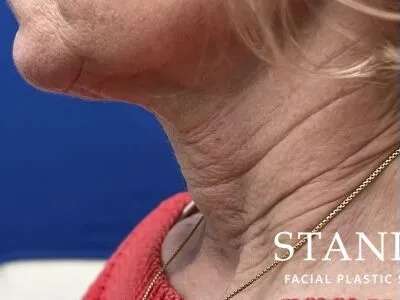 Face/Neck Lift Before & After Patient #470