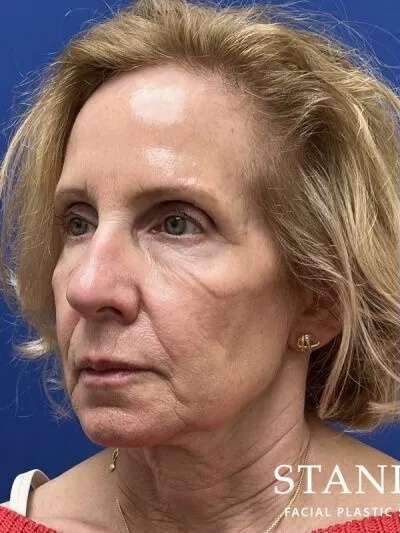 Face/Neck Lift Before & After Patient #470