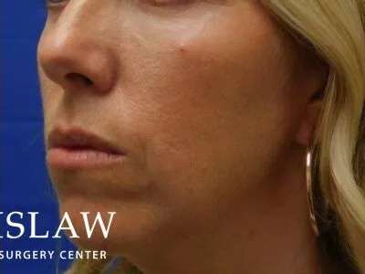 Chemical Peel Before & After Patient #188