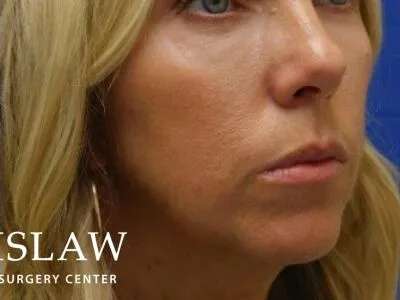 Chemical Peel Before & After Patient #188