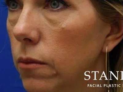 Chemical Peel Before & After Patient #188