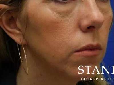 Chemical Peel Before & After Patient #188