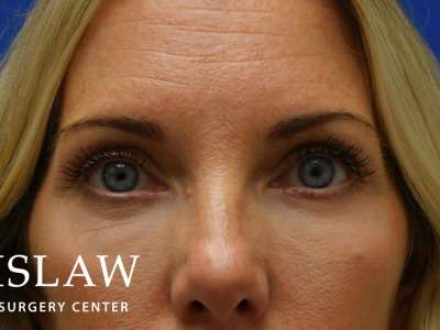 Lower Blepharoplasty Before & After Patient #835