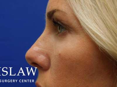 Lower Blepharoplasty Before & After Patient #835