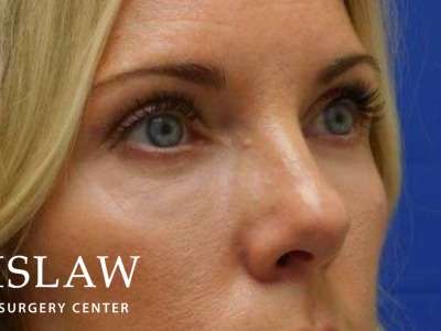 Lower Blepharoplasty Before & After Patient #835