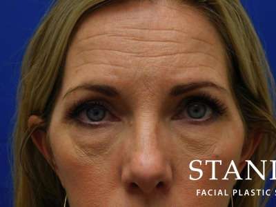 Lower Blepharoplasty Before & After Patient #835