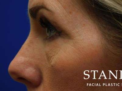 Lower Blepharoplasty Before & After Patient #835