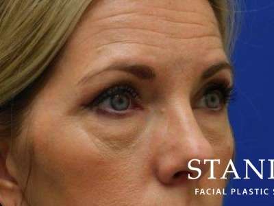 Lower Blepharoplasty Before & After Patient #835