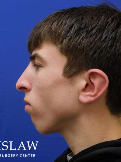 Rhinoplasty Before & After Patient #1134