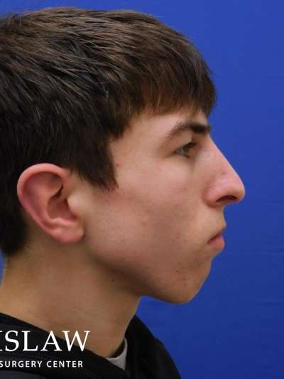 Rhinoplasty Before & After Patient #1134