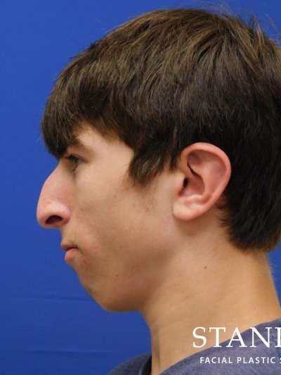 Rhinoplasty Before & After Patient #1134