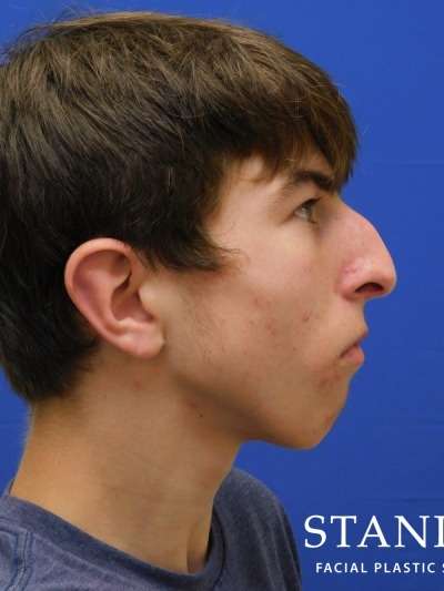 Rhinoplasty Before & After Patient #1134