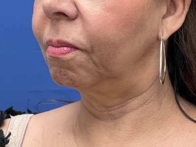 Chin Augmentation Before & After Patient #249