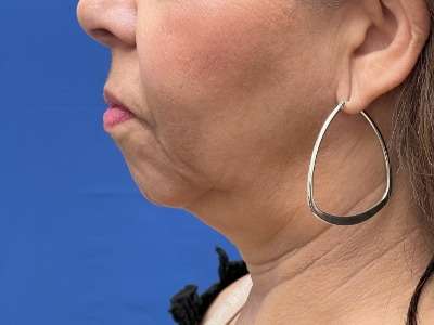 Chin Augmentation Before & After Patient #249