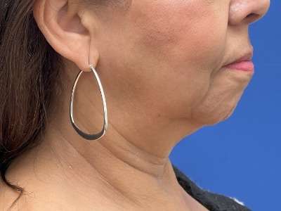 Chin Augmentation Before & After Patient #249