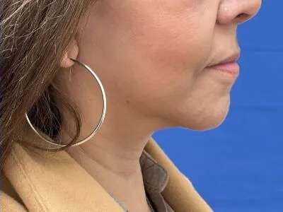 Face/Neck Lift Before & After Patient #481