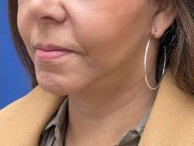 Face/Neck Lift Before & After Patient #481