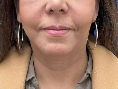 Face/Neck Lift Before & After Patient #481