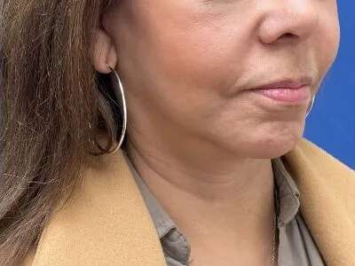 Face/Neck Lift Before & After Patient #481