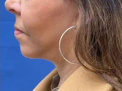 Face/Neck Lift Before & After Patient #481