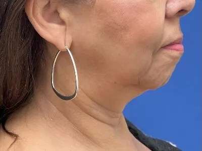 Face/Neck Lift Before & After Patient #481