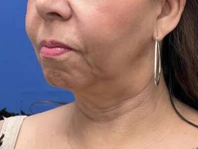 Face/Neck Lift Before & After Patient #481