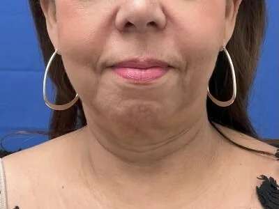 Face/Neck Lift Before & After Patient #481