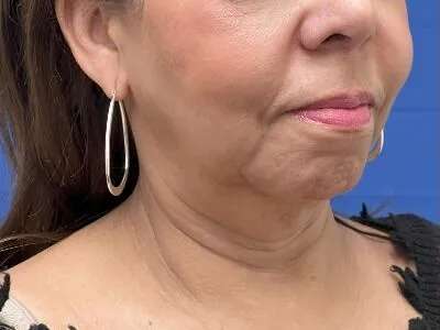 Face/Neck Lift Before & After Patient #481