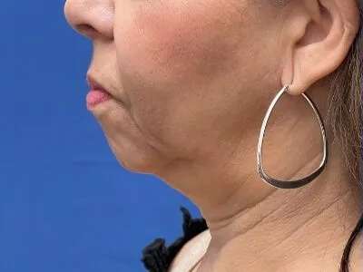 Face/Neck Lift Before & After Patient #481