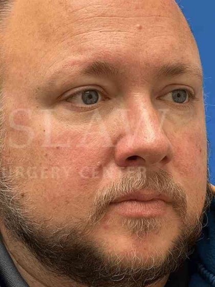 Rhinoplasty Before & After Patient #1127