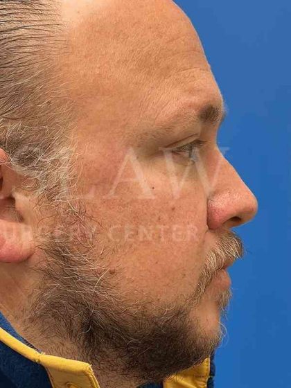 Rhinoplasty Before & After Patient #1127